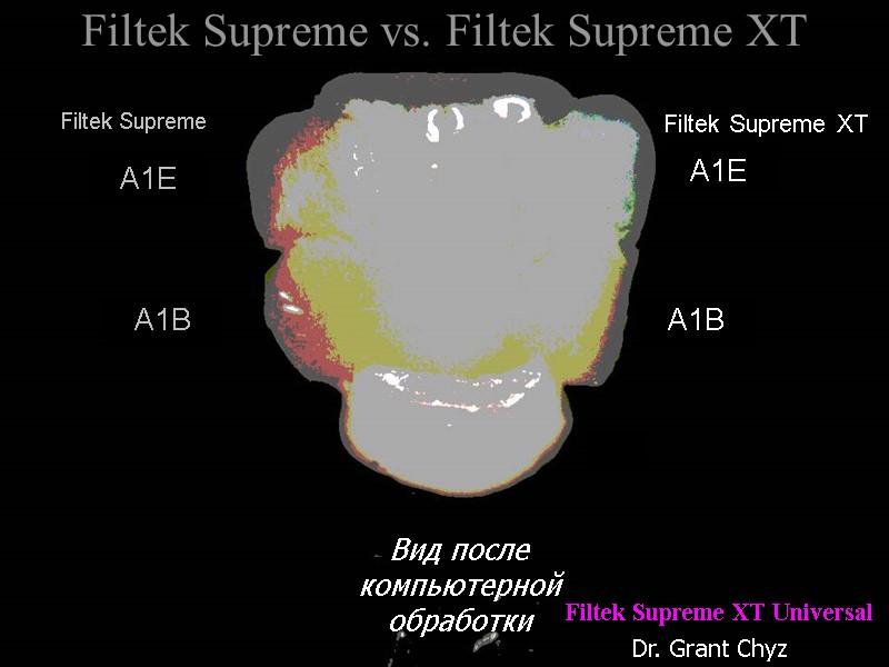 Filtek Supreme vs. Filtek Supreme XT Вид после компьютерной обработки Filtek Supreme Dr. Grant Filtek Supreme vs. Filtek Supreme XT Вид после компьютерной обработки Filtek Supreme Dr. Grant